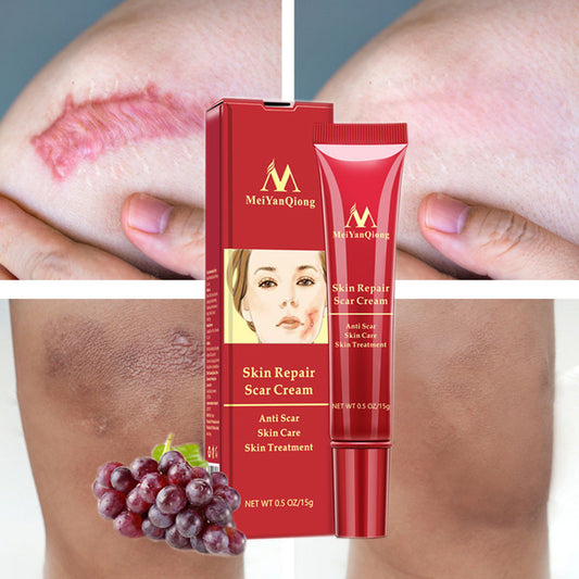 Acne scar removal cream